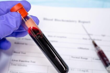 Rajkotupdates.News_EMM-Negative-Rare-Blood-Group-Found-In-Rajkot-Man-11th-Such-Case-Worldwide